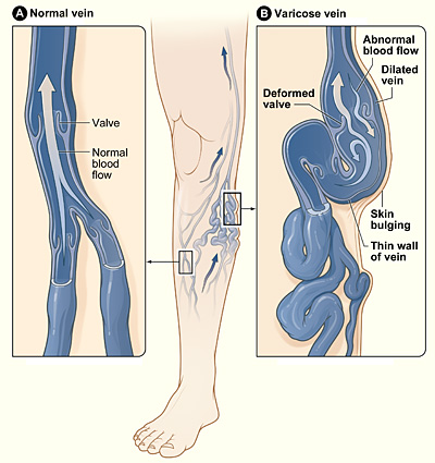 Varicose veins are a common result of standing all day. This illustration shows a normal vein on the left. Blood in the normal vein flows smoothly in one direction. There is a varicose vein on the right. The vein becomes swollen and twisted, and the vein wall is thin.