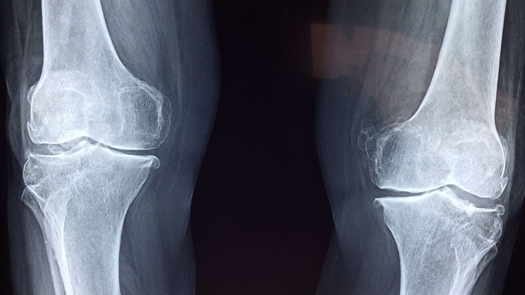 An X-ray image of two knees