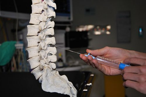 A doctor practices performing an epidural injection using a model spine. The spine in on the left, and only the doctor's hands are visible on the right. The needle looks to be about as long as a hand.