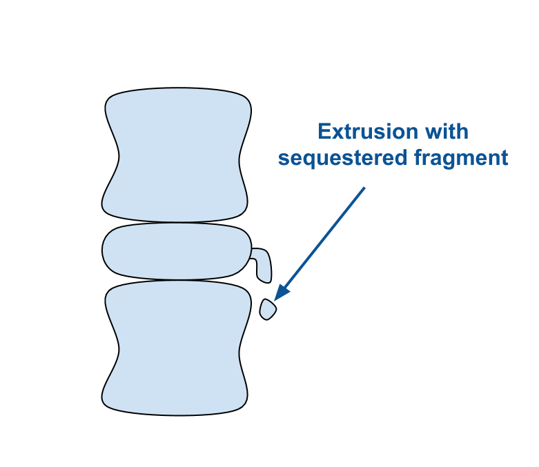 An illustration of two vertebrae, with a disc sandwiched between. A disc extrusion is visible on the right side of the disc. A small fragment of the extrusion has broken off, and is hovering below the main mass. This loose piece is labeled "Extrusion with sequestered fragment."