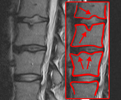 This is an MRI showing several Schmorl's nodes. The image is actually repeated twice; once on the left, and once on the right. The image on the right has red lines drawn around the vertebral bodies, and arrows to point out the locations of Schmorl's nodes. It's impossible to tell which spinal levels these images are from.