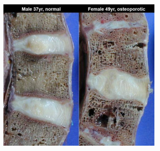 This photo consists of two panels. The one on the left shows a cross-section of a normal human spine. The caption reads, "Male 37yr. normal". The trabeculae in the vertebrae are arranged in a tight grid. The intervertebral discs are mostly flat, and look distinctly like poached eggs. The panel on the right is captioned, "Female 49yr. osteoporotic". Her vertebrae look like used sponges. The weave of the trabeculae is more open, and there are large holes in the structure of the bone. The top disc looks smooshed, while the second disc has swelled and expanded, so that it takes up a fair bit of space that should be occupied by bone.