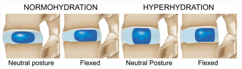 This illustration has four panels with drawings showing the location of the nucleus and the pressure on the annulus. The two left panels show discs in a state of normal hydration, while the right two panels show discs in a state of hyperhydration. For each of these, discs are shown in a neutral posture and flexed posture. While in a neutral posture, the nucleus is centered in the disc, and the forces are evenly distributed around the annulus. In a flexed position, the nucleus pushes towards the back of the spine, and forces are concentrated in the back of the annulus. The hyperhydrated disc is taller, and in a flexed position, greater force is directed to the back of the annulus.