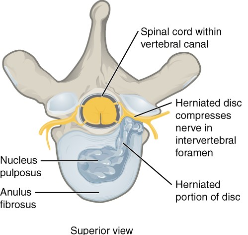 An illustration of the cross-section of a vertebrae and disc. The thick outer band of the annulus has been breached, which allows the nuclear material to seep out. However, it doesn't cut a straight path through, but winds its way around through the annulus.