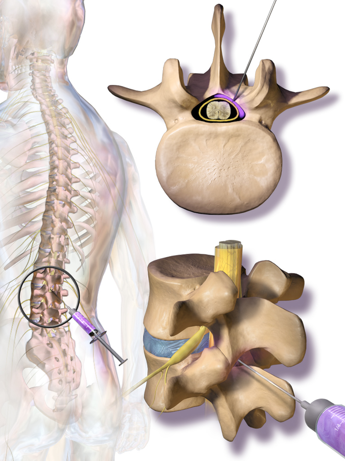 A medical illustration of a lumbar epidural injection. One image shows the placement of the needle in relation to the spine. Two blowup images show 1) the top view of the vertebrae, and 2) a close-up of the vertebrae from the rear left side.