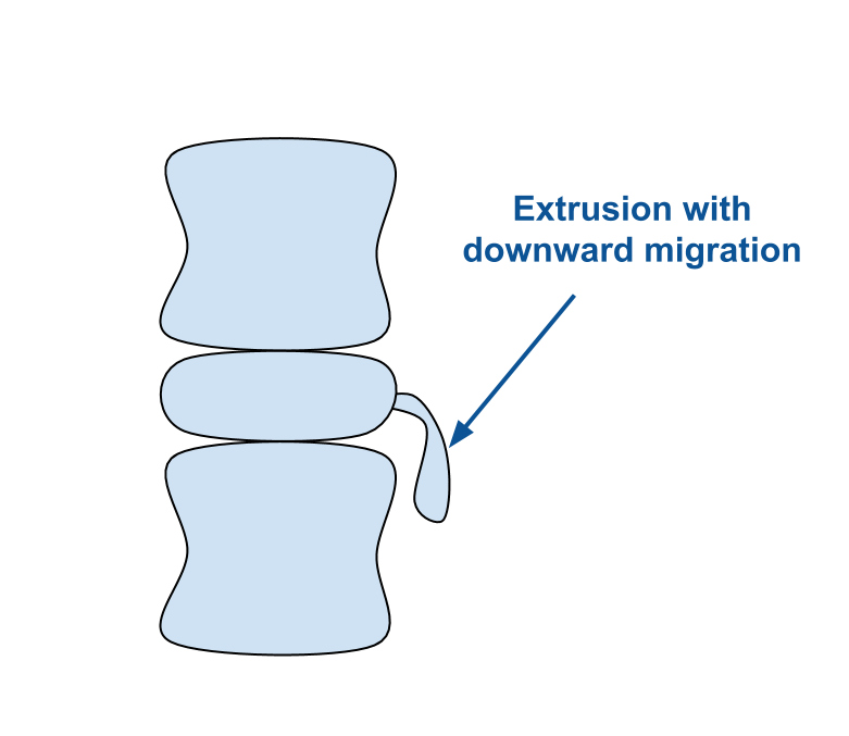 An illustration showing two vertebrae with an intervertebral disc sandwiched between. There is long strand of material shown exiting the disc and poking down toward the lower vertebrae. The strand is labelled "Extrusion with downward migration."